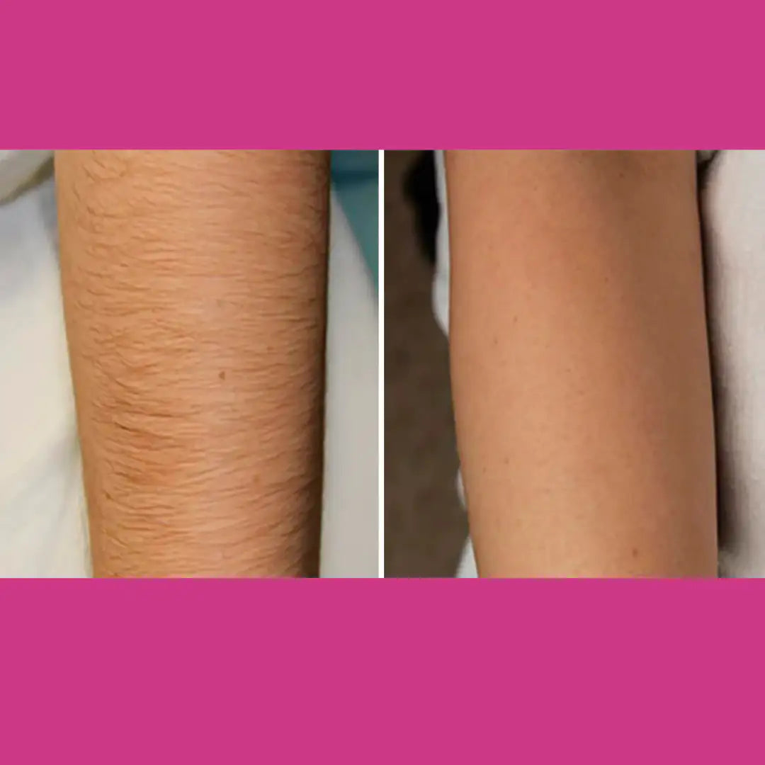 MEEOW 10-Min Painless DIY Hair Removal Mask